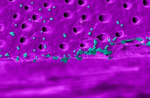 Szubmikron méretű részecskék egy emberi fog felületén